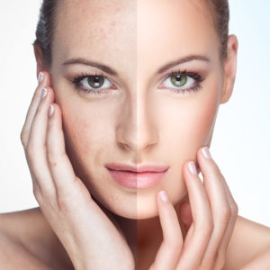 close-up of woman's face before and after treatment