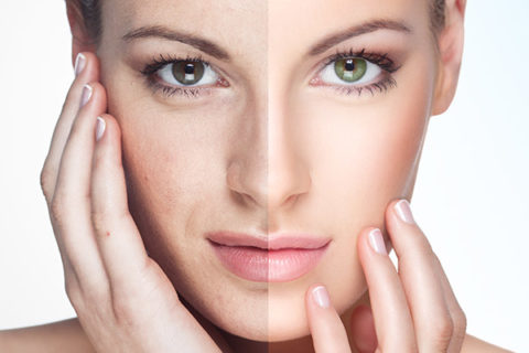 close-up of woman's face before and after treatment