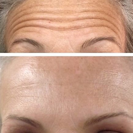 Dysport Injections For Glabella Lines
