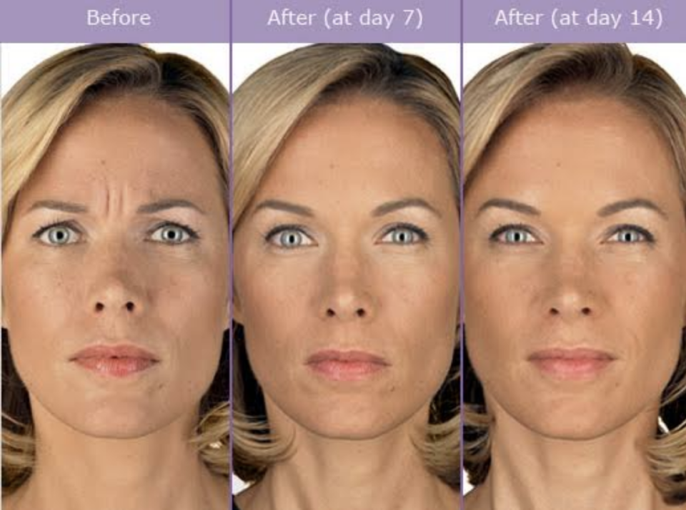 Dysport Injections Sykesville and Eldersburg MD