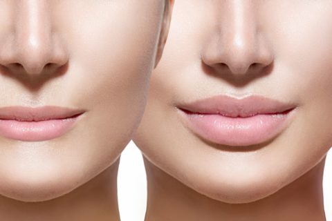 Dysport Plus Dermal Fillers