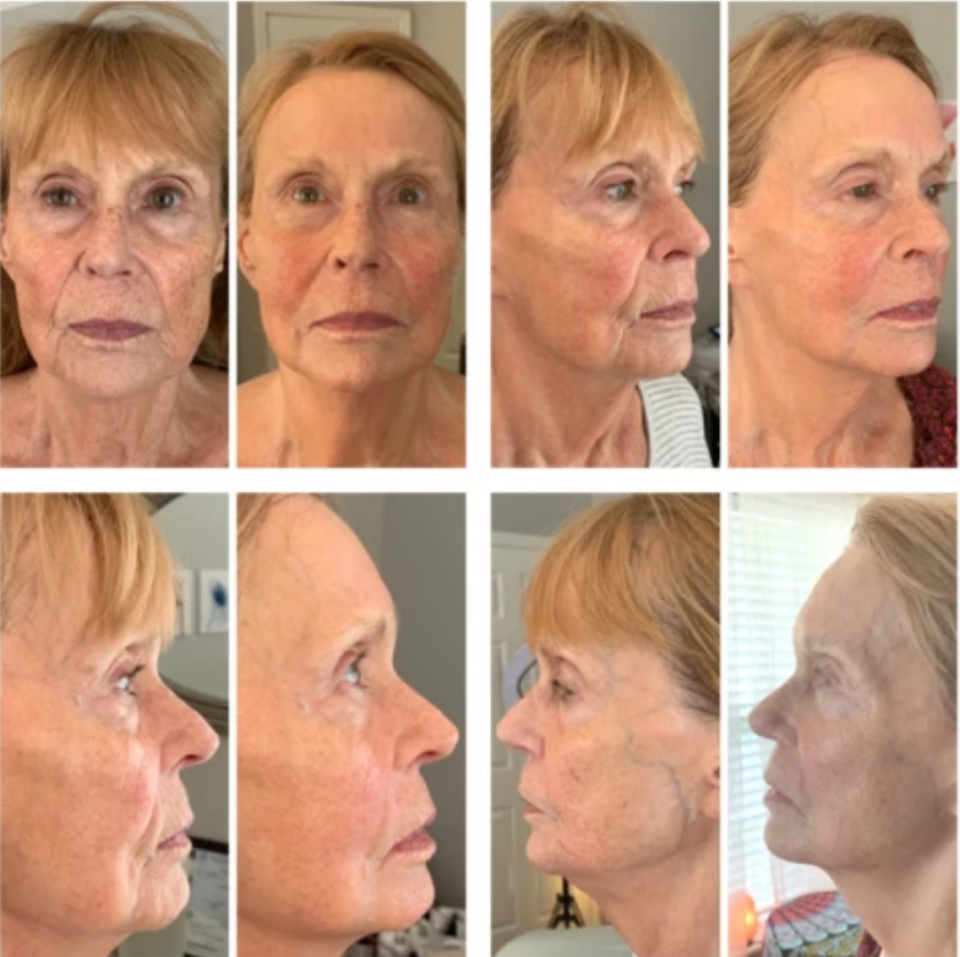 Scullplla Before & After