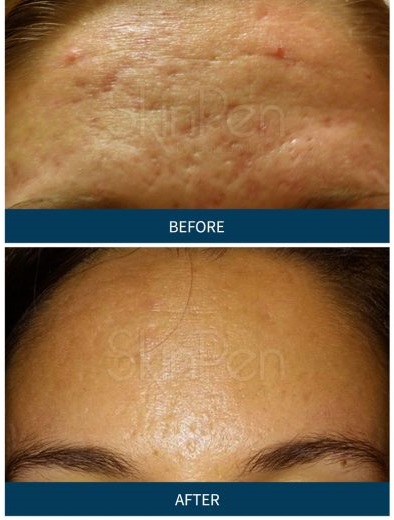 MD Pen Skin Rejuvenation With MicroNeedling on the EC! 