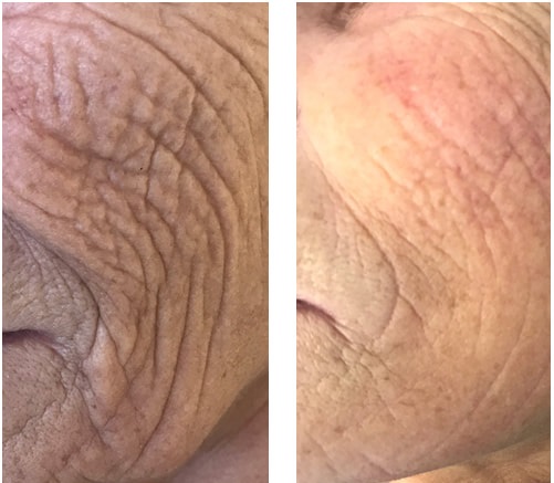 Plasma Pen Skin Tightening on cheeks