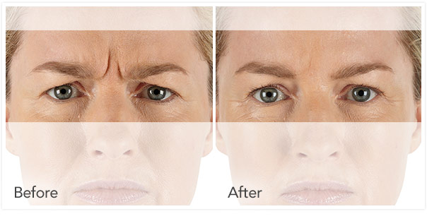 Xeomin Injections Sykesville