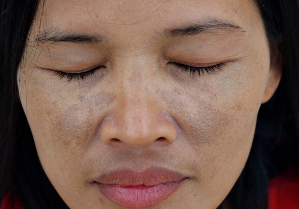 hyperpigmentation treatment