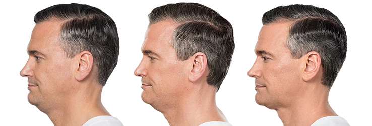 Kybella before after