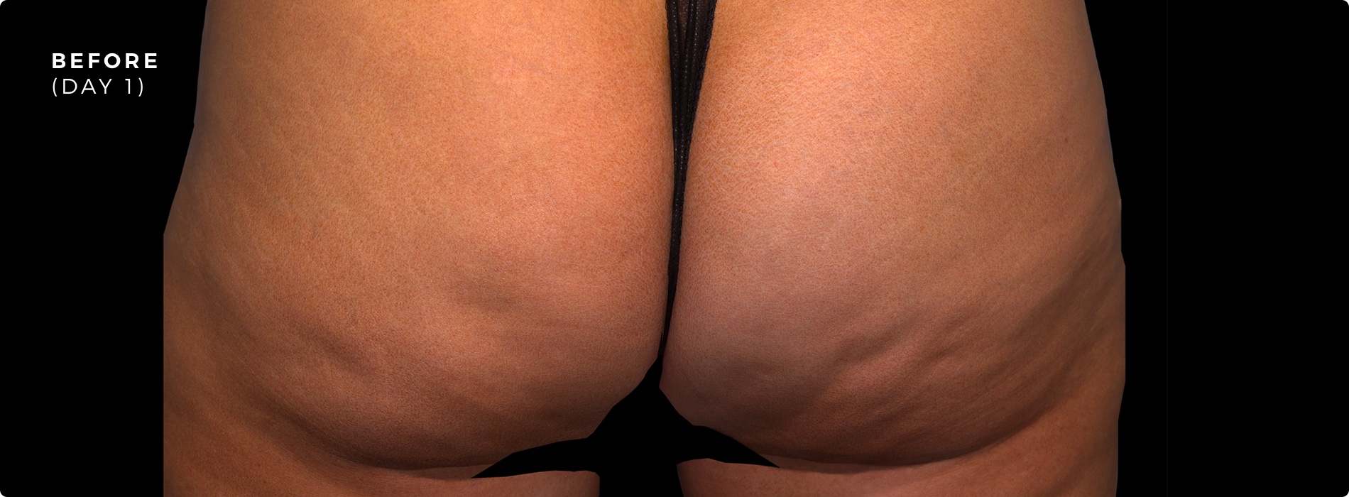 Prior to Maryland Cellulite Treatment