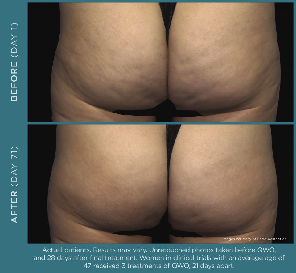 MD Cellutite Treatment
