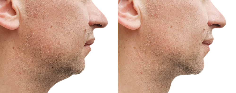 Male Kybella Injection