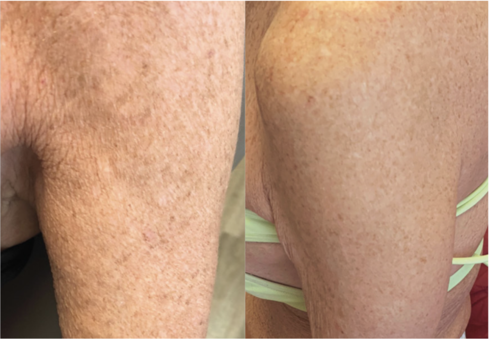 BBL Body Treatment Sykesville