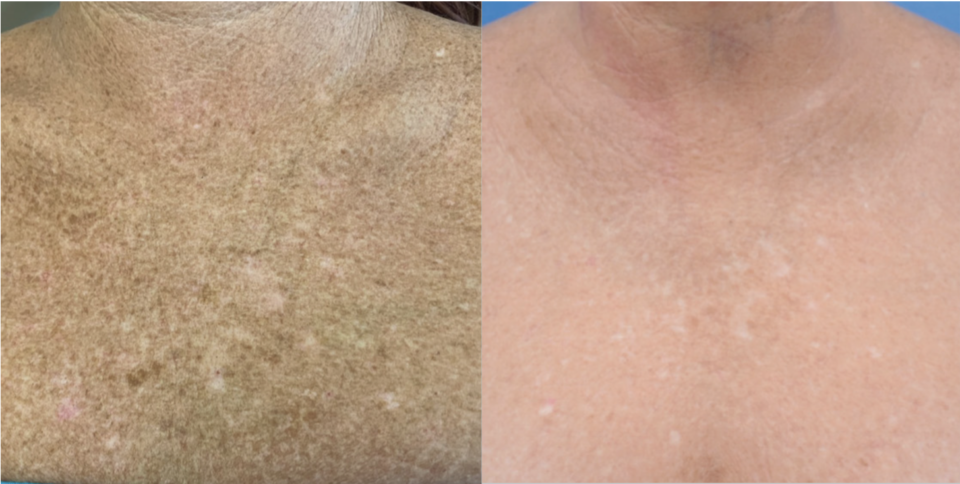 BBL Hero Sykesville before after