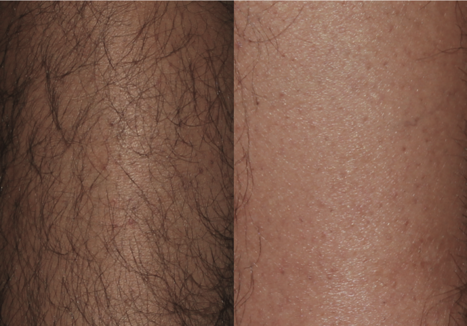 Laser Hair Removal Eldersburg MD