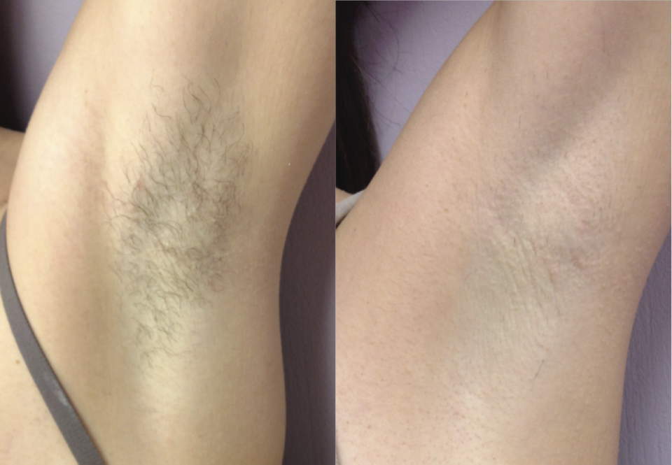 Armpit Hair Removal Sykesville MD